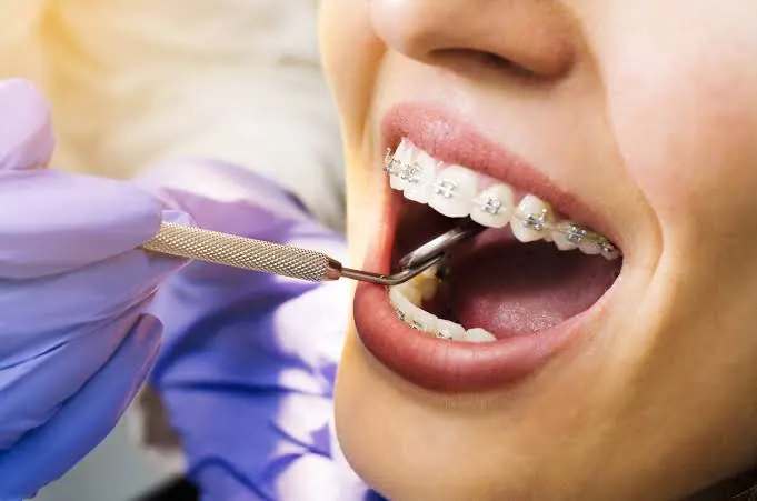 Certified Orthodontics and Braces treatment at Narowal Dental Clinic